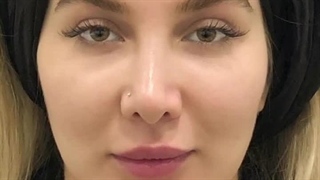 فرمدهی صورت