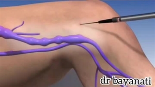 دلایل گشاد شدن رگ های قلب