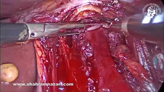 میوتومی هلر و تست بلودومتیلن در اتمام عمل آشالازی