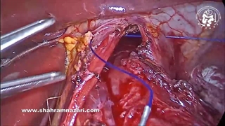 اضافه کردن فوندوپلیکاسیون به عمل جراحی آشالازی مانع ریفلاکس پس از جراحی آشالازی میشود