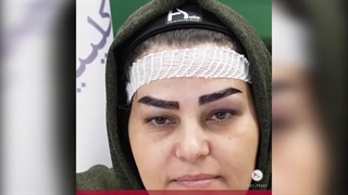تجربه ای به یاد ماندنی از کاشت ابرو در کلینیک هلیا