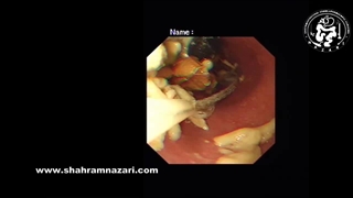 گیر کردن لقمه غذا و انباشته شدن مواد غذایی در مری آشالازی