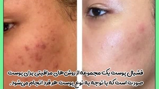 فیشیال پوست ماموپلاستی