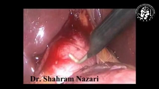 کیسه صفرا ساعت شنی