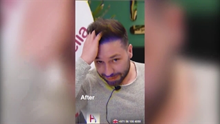 From Thinning to Lush Hair (Before and After Images)