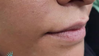 هزینه تزریق ژل لب