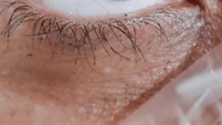 تزریق مزو زیر چشم در کرج