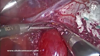میوتومی هلر در درمان جراحی آشالازی (روش لاپاروسکوپی)