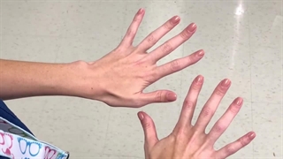 اسکراب جراحی