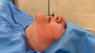 هزینه ساکشن غبغب مشهد + لحظه بعد از برداشتن ساکشن غبغب