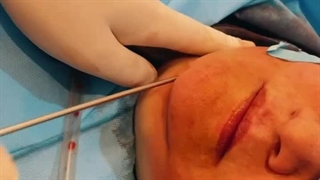 هزینه ساکشن غبغب مشهد + فیلم برداشتن غبغب