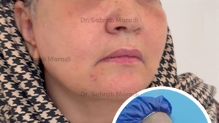 جراحی لیفت صورت _ بهترین جراح زیبایی در تهران