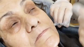 بوتاکس فول فیس