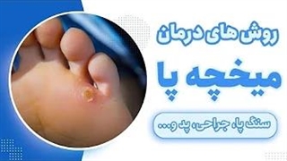 روشهای درمانی برای رهایی از میخچه پا
