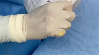 بررسی پروتز سینه برند موتیوا motiva در مشهد قبل از قراردادن