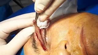 نحوه برداشتن چربی پلک بالا (بلفاروپلاستی مشهد)