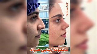 قبل و بعد عکس عمل بینی در مشهد: نتایج واقعی مراجعین و تغییرات چشمگیر! دندان پیش