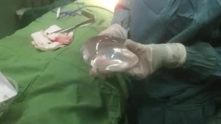 چک پروتز سینه در اتاق عمل