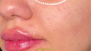 تزریق فیلر زیر چشم