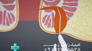 عمل و نحوه درمان فیستول با لیزر