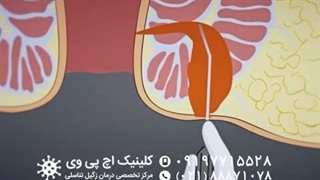 مراحل درمان فیستول با لیزر جوانسازی پوست