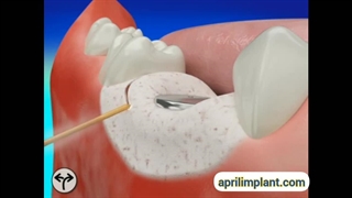 فیلم ایمپلنت دندان با لیزر