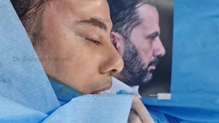 لیفت اندوسکوپی ابرو توسط دکتر سهراب مرادی رفع افتادگی پلک