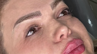 تزریق ژل لب