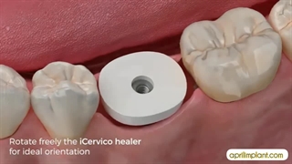 فیلم ایمپلنت سوئیسی