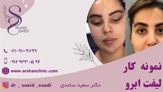نمونه کار جراحی لیفت ابرو