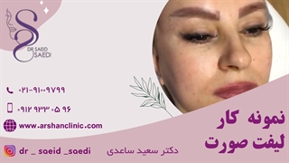 نمونه کار لیفت صورت