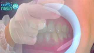 انجام بلیچینگ آفیس توسط دکتر نگین اثنی عشری کاشت ابرو