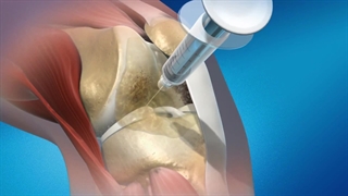 تزریق ژل زانو