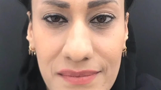 یکسال پس از جراحی بینی