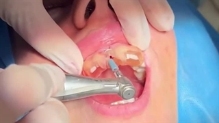 فیلم ایمپلنت دندان جلو