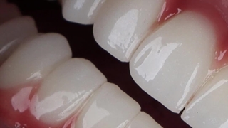 فیلم مراحل ایمپلنت دیجیتال دندان