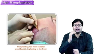 کاشت مو به روش میکروفیت