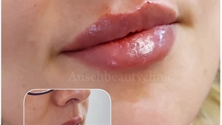تزریق ژل لب طبیعی در کرج