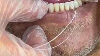 برطرف کردن لقی دندان مصنوعی با لثه ضعیف