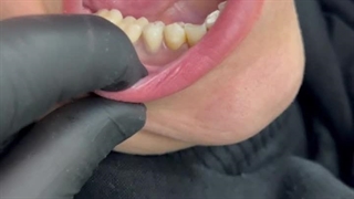 فیلم بهترین دندان مصنوعی برای افراد جوان