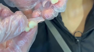 فیلم گذاشتن دندان مصنوعی تکه ای