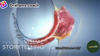 آرتریت رومانوئید