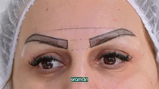 کاشت ابرو به روش fit
