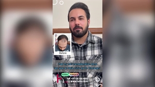 Hair transplant: extraordinary hair density without the need for surgery!