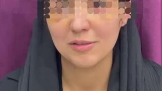 نظرات در مورد بلفاروپلاستی مشهد