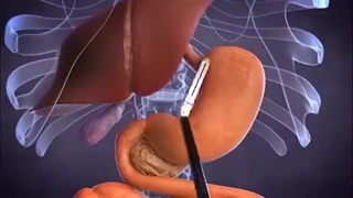 مینی بای پس