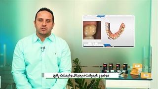 ایمپلنت دیجیتال و ایملنت پانچ