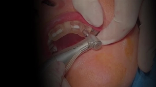 کاشت ایمپلنت دیجیتال دندان در تهران