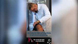 Up to 95% hair density can be attained through the latest transplantation methods