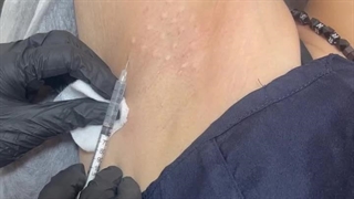 بوتاکس زیربغل